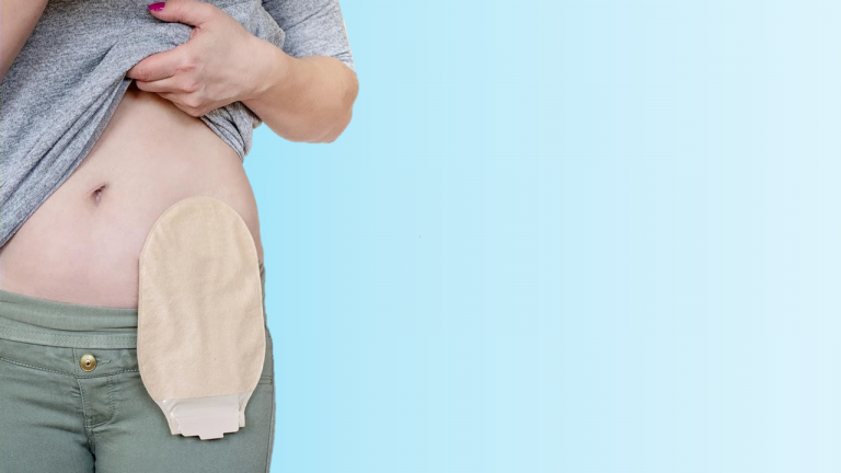 Lee más sobre el artículo ¿Cómo prepararse para una colostomía?